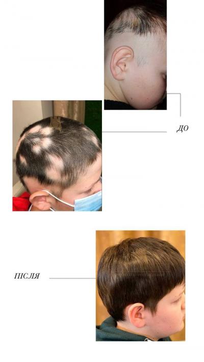 Лікування випадіння волосся у дітей