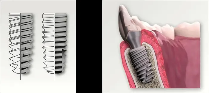 Современные методы имплантации зубов