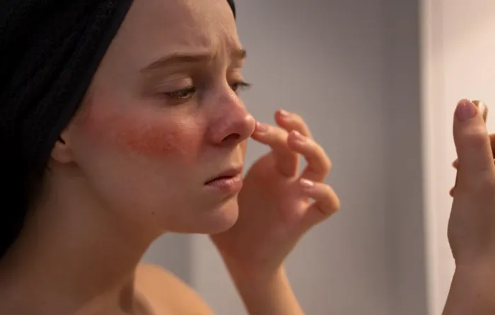 Лечение розацеа в домашних условиях – возможно ли это?